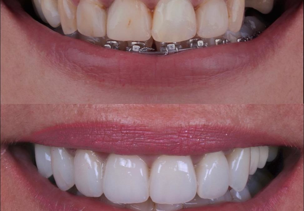 Dentalepe carillas esteticas