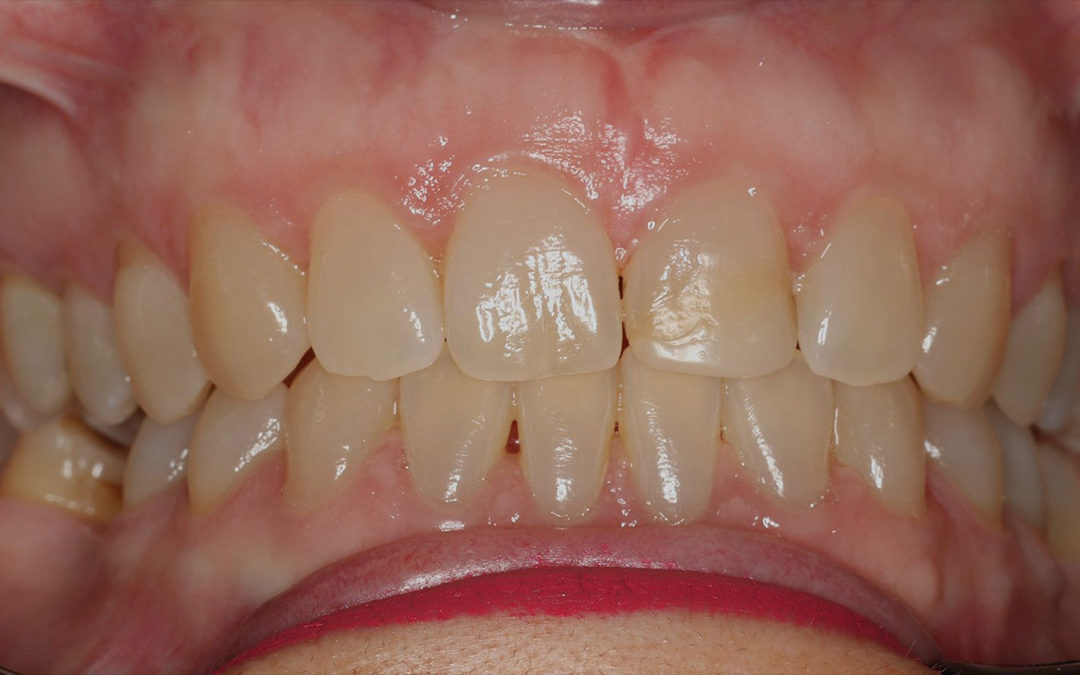 Ortodoncia invisible para la corrección de diastema