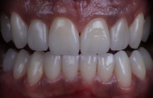 Carillas estéticas para mejorar color y forma de los dientes