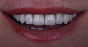 Colocación de carillas dentales y sustitución de coronas y puentes