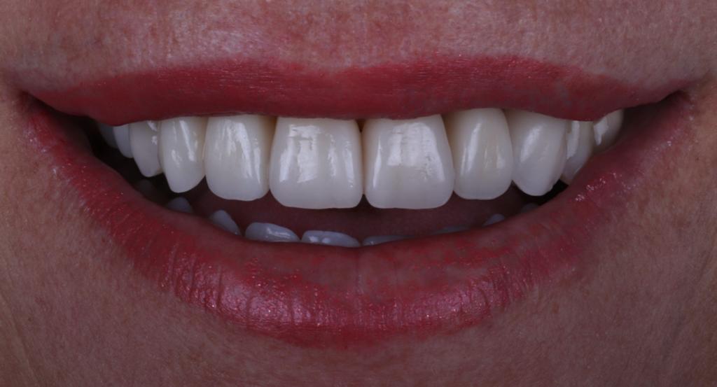 Colocación de carillas dentales y sustitución de coronas y puentes