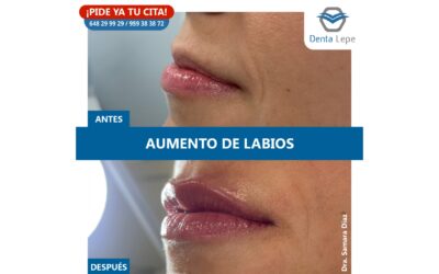 Medicina estética. Aumento de labios