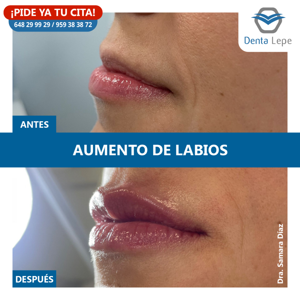 Medicina estética. Aumento de labios