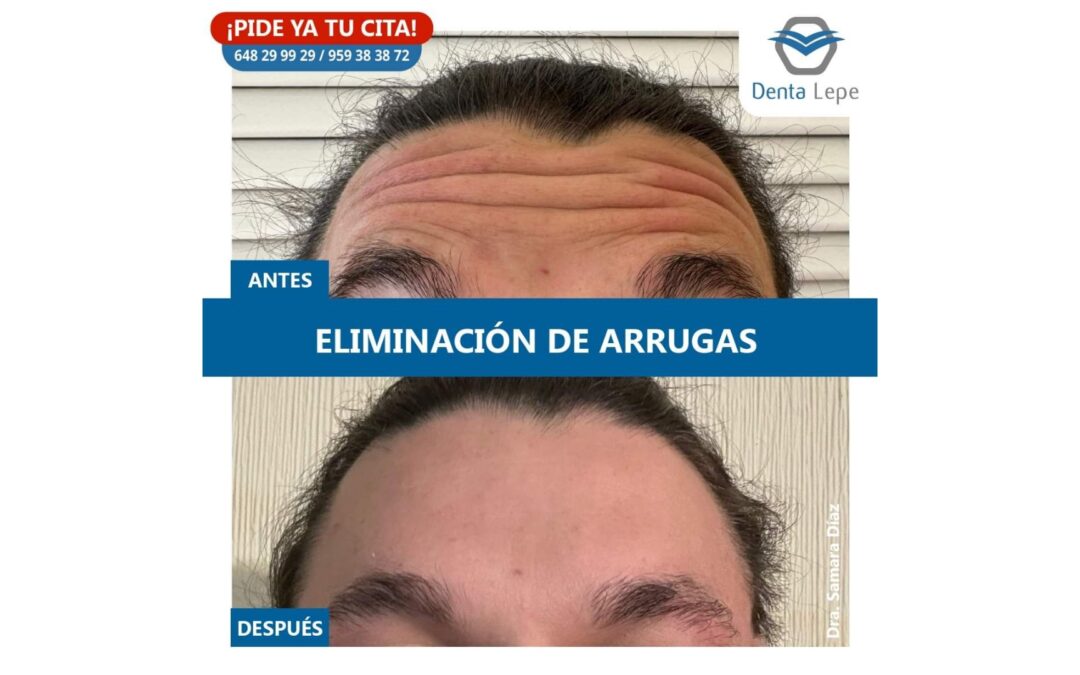 Medicina estética. Eliminación de arrugas