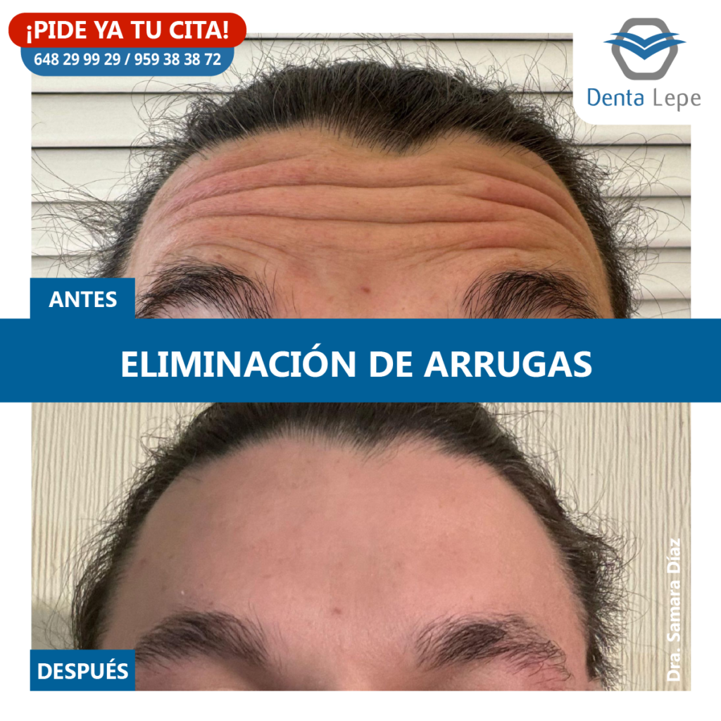 Medicina estética. Eliminación de arrugas